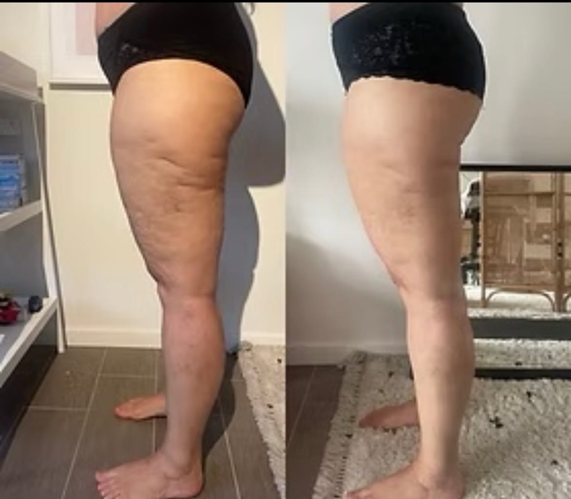 Customer photo review of Bottes de Pressothérapie Novaa® Pro - Massage à compression d'air