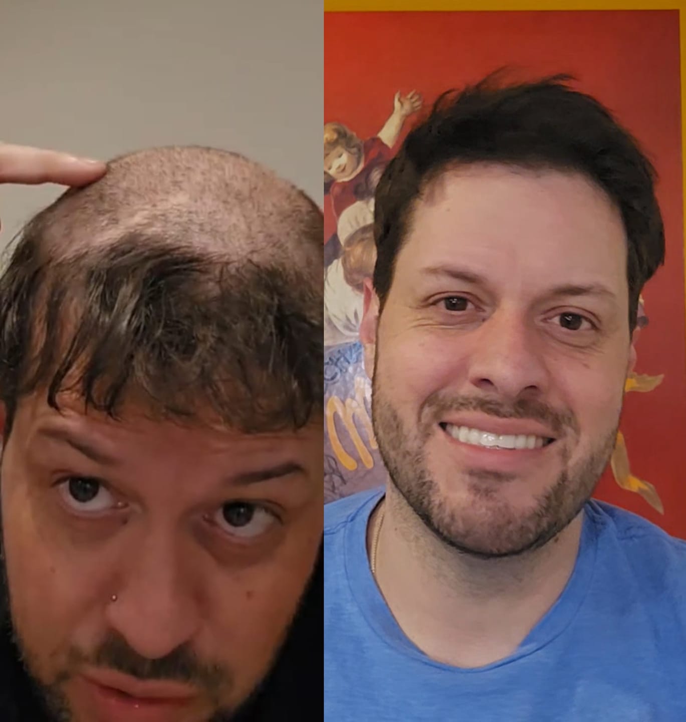 Customer photo review of Men Toupee V-loop 0204mm Ultra-thin skin base Sage