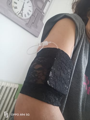 Customer photo review of Lace Armbands to Protect CGM and Insulin Pump - Dia-Band SPACY LACY