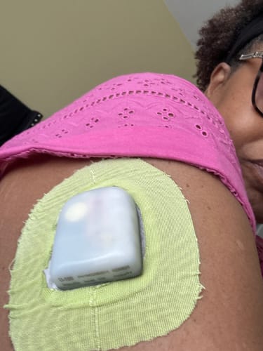 Customer photo review of Skin Grip Original - Omnipod Adhesive Patches