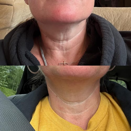 Customer photo review of Dermave™ Eye & Neck Care Set