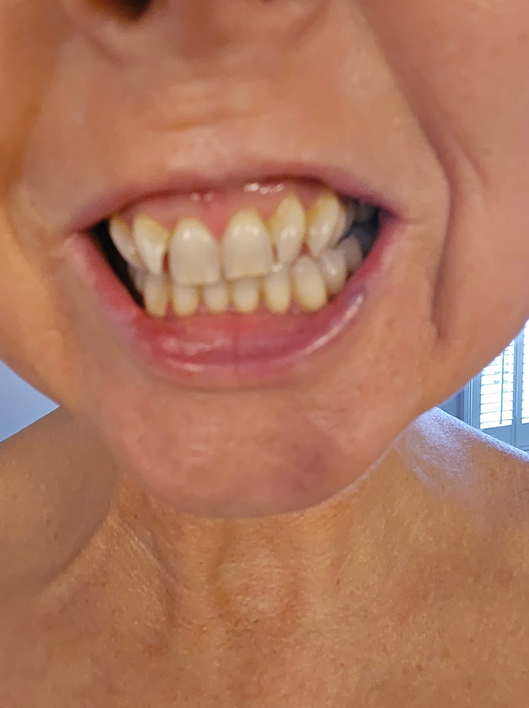 Customer photo review of Teeth Whitening Strips