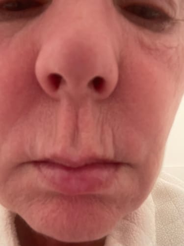 Customer photo review of Natural Botulin 8-Wochen-Microinfusion-System™
