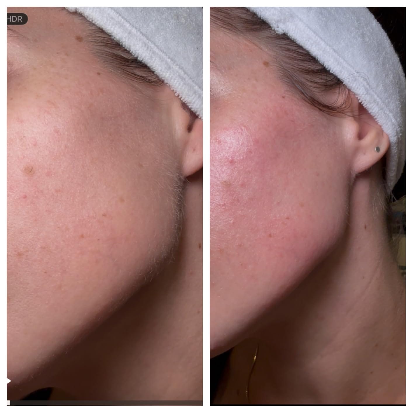 Customer photo review of Trim Pod 3.0  : The Best Dermaplaning Tool For Women Over 40