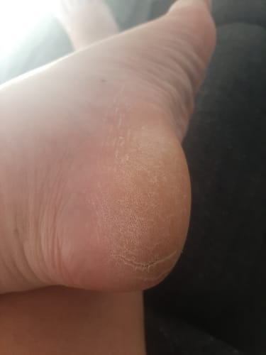 Customer photo review of LOVASKIN INSTANT FOOT PEEL Deluxe Kit - 25 applications or less than 3.20 per treatment