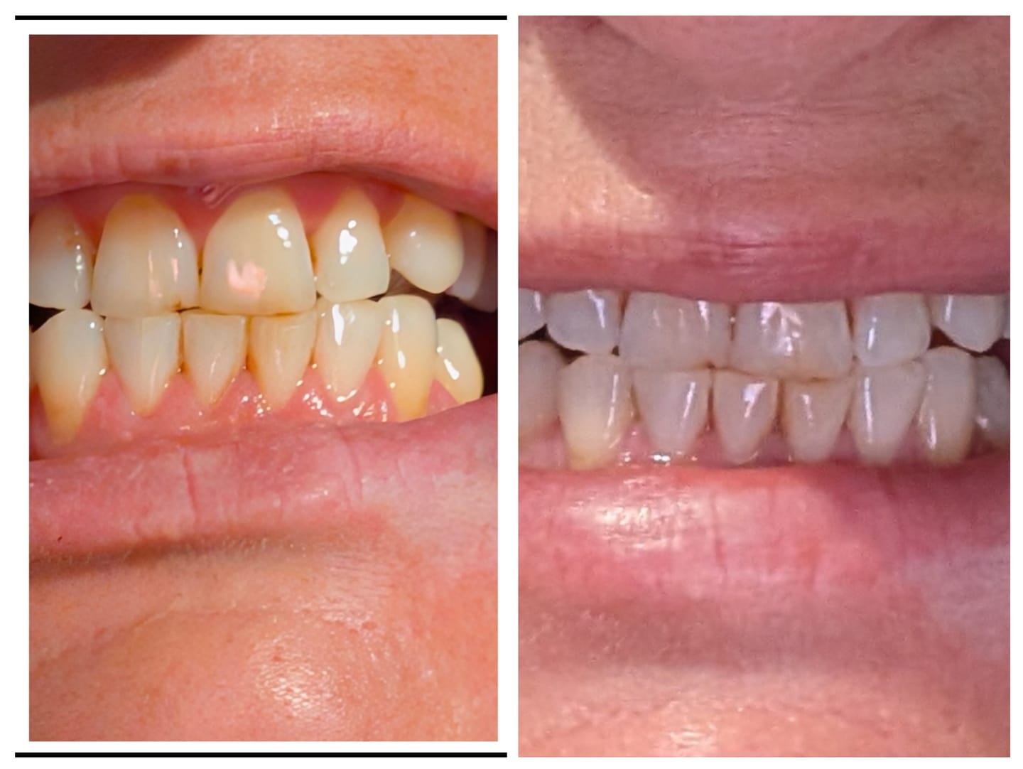Customer photo review of Advanced Teeth Whitening Kit