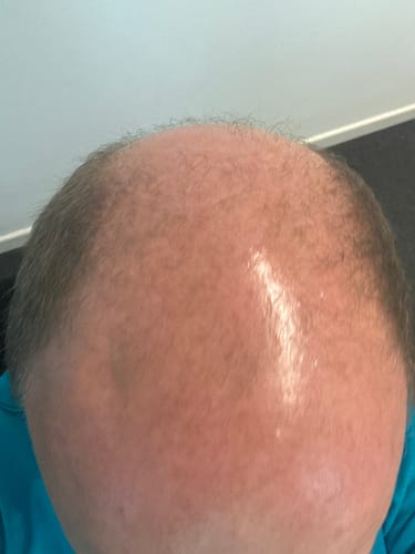 Customer photo review of Sérum au Redensyl Activateur de Pousse Cheveux