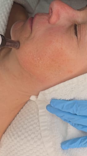 Customer photo review of 12 Pin Replacement Cartridges for A7 DermaHeal 10X