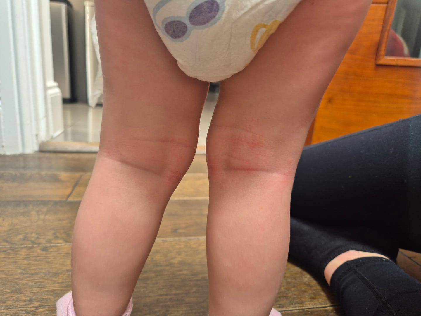 Customer photo review of Bioskin Junior Outbreak Rescue Cream
