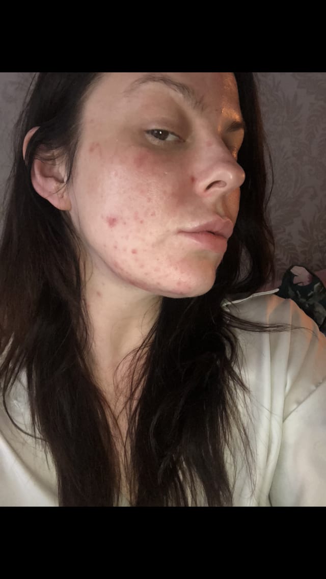 Customer photo review of Estrogen Reset Kit (DIM + Estro Broccoli Complex)