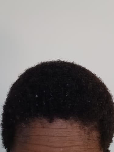 Customer photo review of Rennora Hair Growth Serum