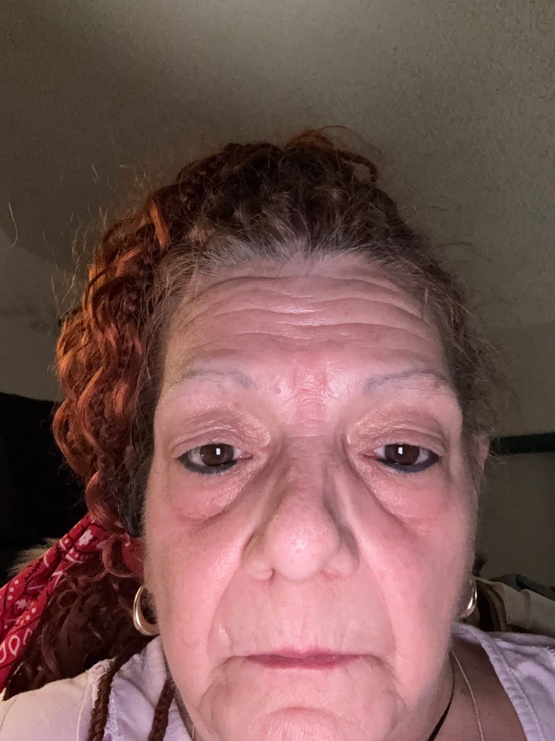 Customer photo review of Glov Intense Rejuvenation Eye Gel Patches