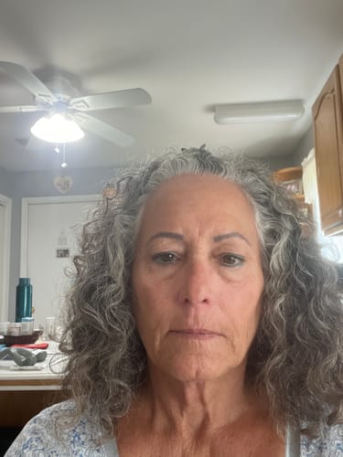 Customer photo review of 3 Month Supply - Seranova Micro Infusion System