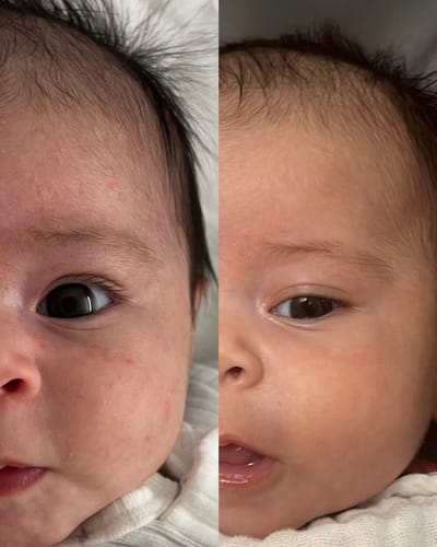 Customer photo review of All Over Ointment Eczema Treatment