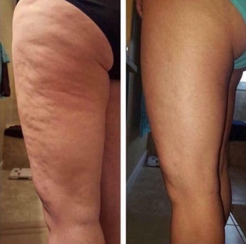 Customer photo review of Eliminá la Celulitis y las Estrías desde la Raíz: Guía Completa para una Piel Suave y Firme + 20 Regalos Extras