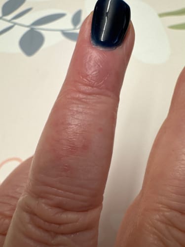 Customer photo review of All Over Ointment Eczema Treatment