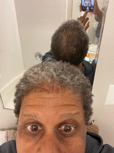 Customer photo review of Two Bottles of Rennora Hair Growth Serum