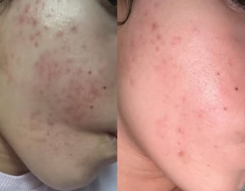 Customer photo review of Advanced Acne Program™