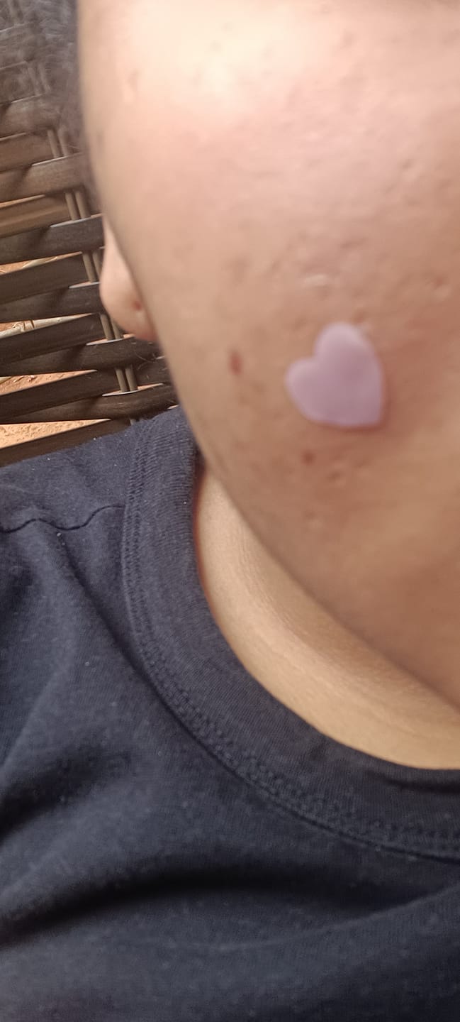 Customer photo review of Adesivos Secativos para Espinhas - Bye Bye Acne