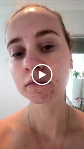 Customer video review of Starter Acne Program™
