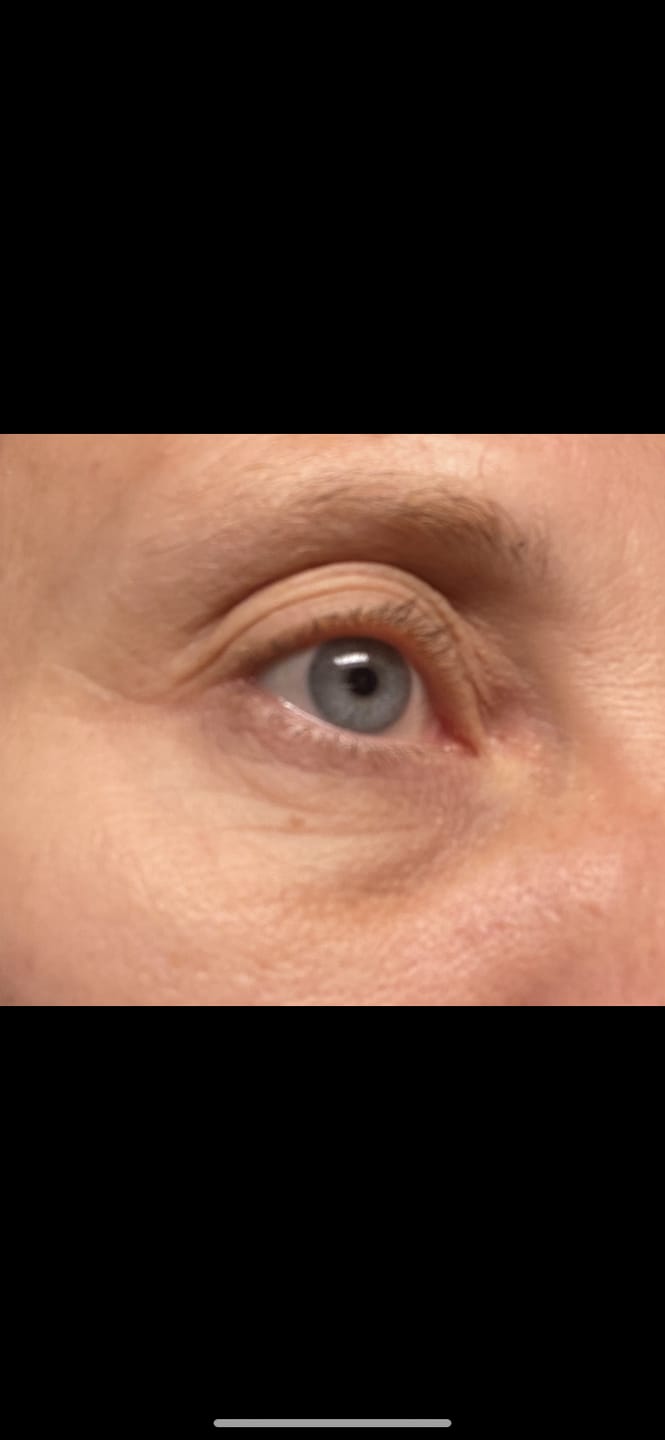 Customer photo review of Ecume - Patchs anti-cernes