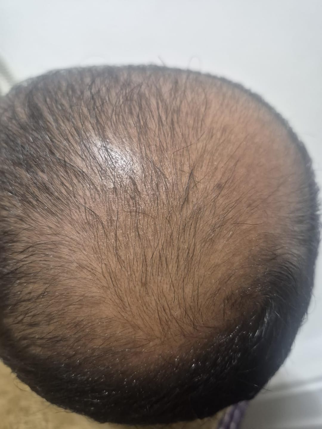 Customer photo review of SÉRUM CAPILLAIRE MULTI ACTIF BIO-DENSYL®