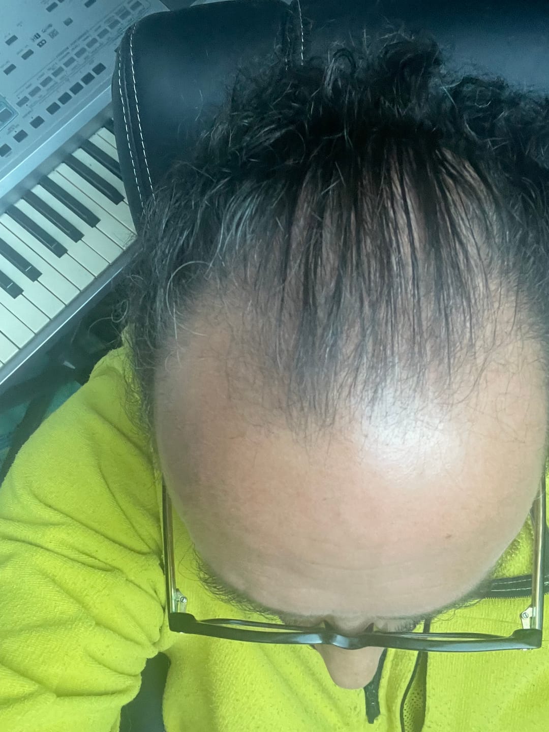 Customer photo review of SÉRUM CAPILLAIRE MULTI ACTIF BIO-DENSYL®
