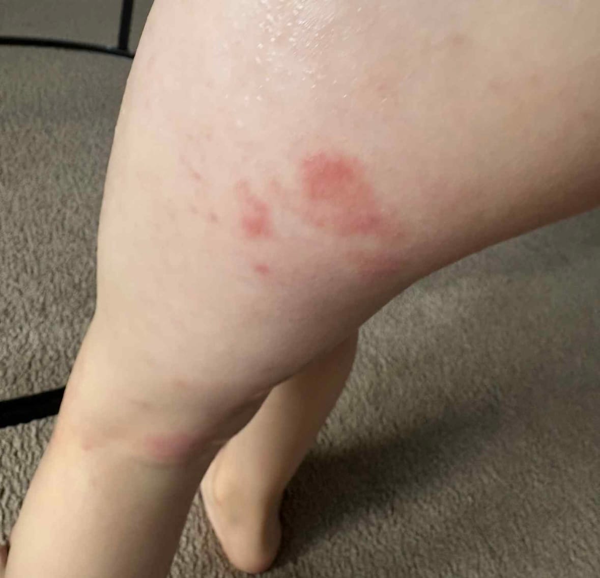 Customer photo review of Bioskin Junior Outbreak Rescue Cream