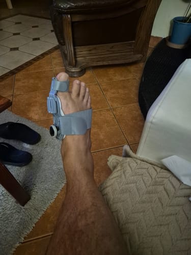 Customer photo review of Ortolin Éjszakai Bütyökvédő és Lábujj Korrigáló Sín