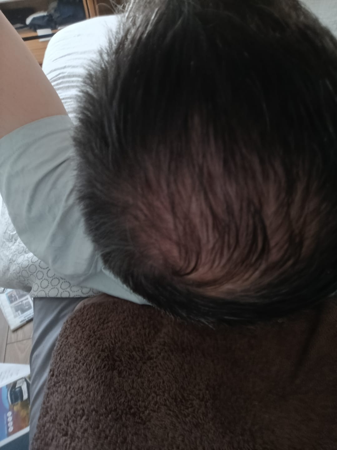 Customer photo review of SÉRUM CAPILLAIRE MULTI ACTIF BIO-DENSYL®