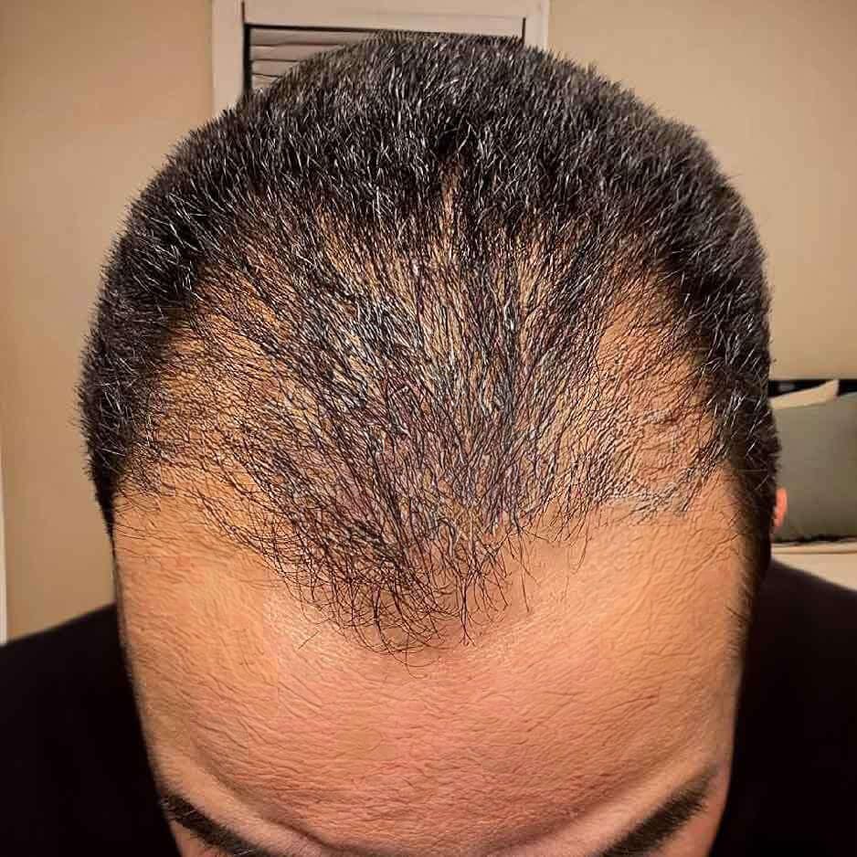 Customer photo review of SÉRUM CAPILLAIRE MULTI ACTIF BIO-DENSYL®