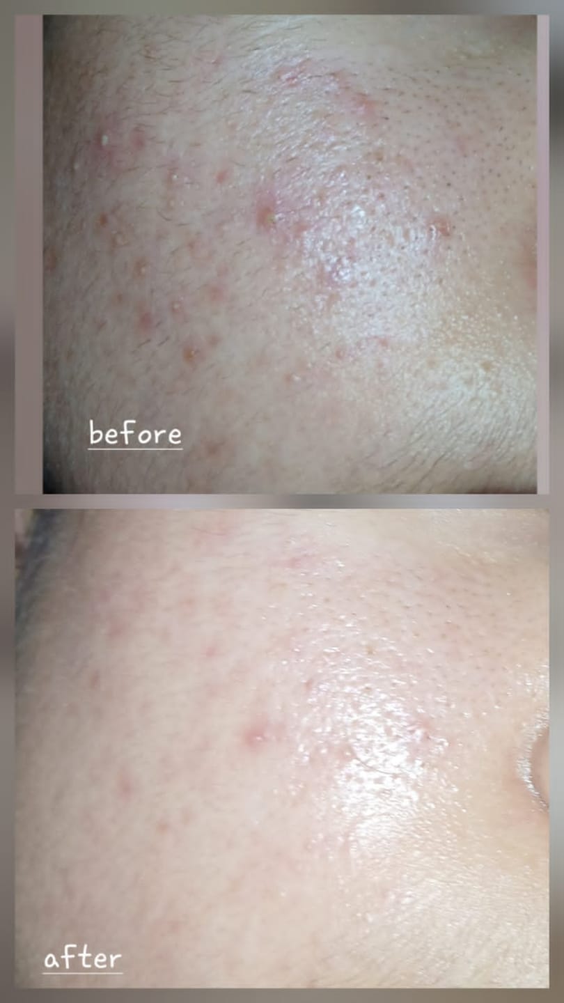 Customer photo review of MandelAC Serum