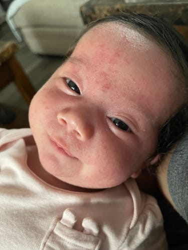 Customer photo review of All Over Ointment Eczema Treatment