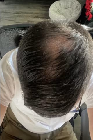 Customer photo review of SÉRUM CAPILLAIRE MULTI ACTIF BIO-DENSYL®