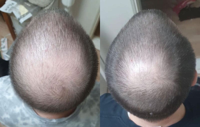 Customer photo review of SÉRUM CAPILLAIRE MULTI ACTIF BIO-DENSYL®