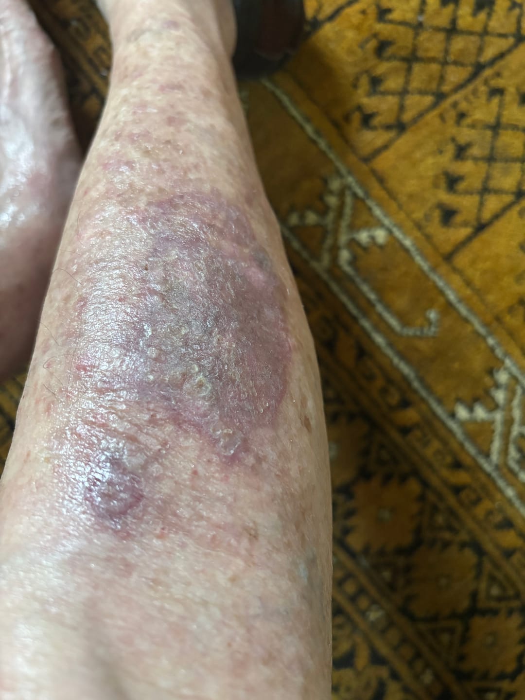 Customer photo review of Bioskin Zeoderm Skin Repair Moisturiser