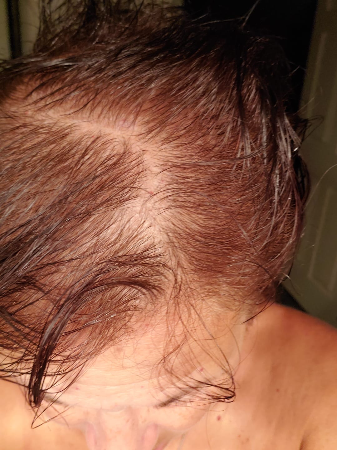 Customer photo review of SÉRUM CAPILLAIRE MULTI ACTIF BIO-DENSYL®