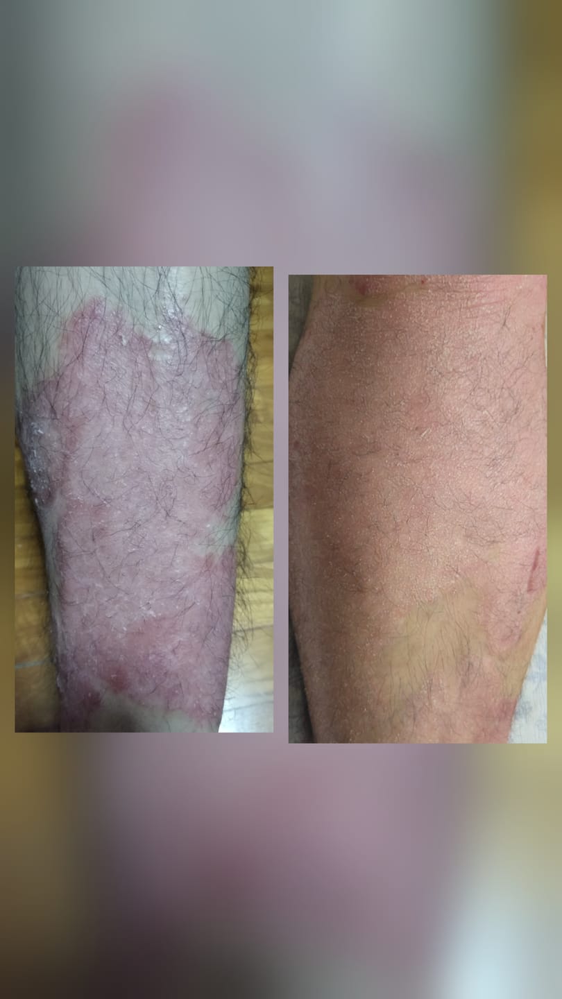 Customer photo review of Balance Fusion Combo (2 RCV + 2 NSE)