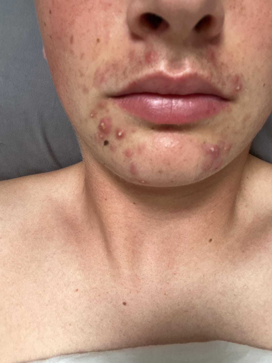 Customer photo review of Instant Rosacea, Acne & Redness Stopper