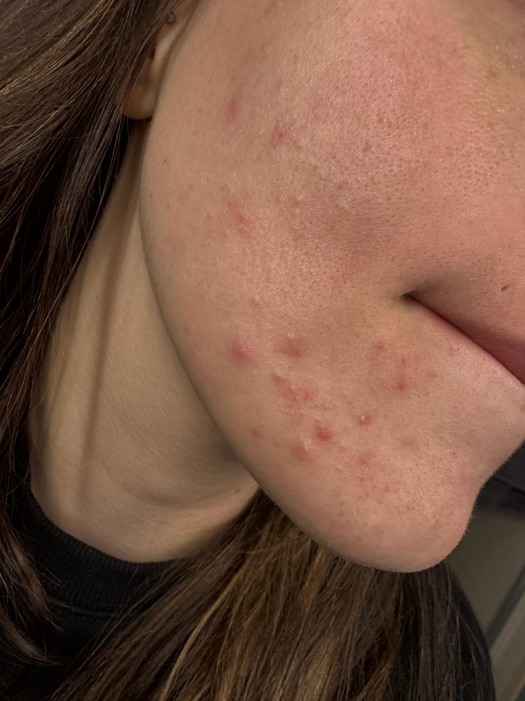 Customer photo review of The Complete Acne Killer System 2.0
