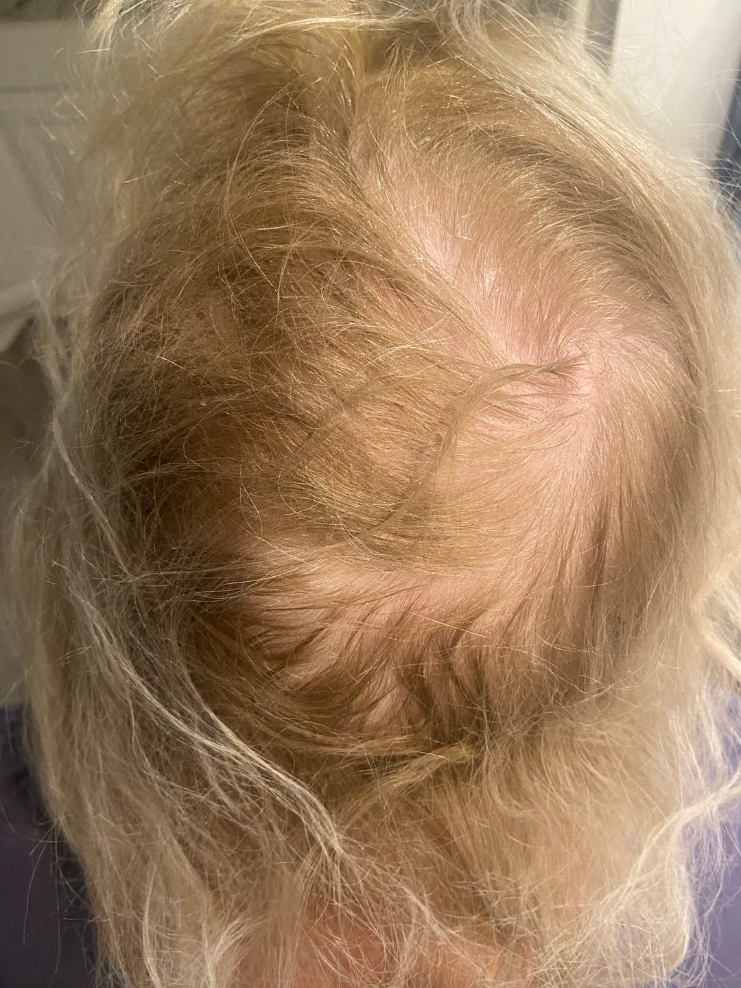 Customer photo review of SÉRUM CAPILLAIRE MULTI ACTIF BIO-DENSYL®