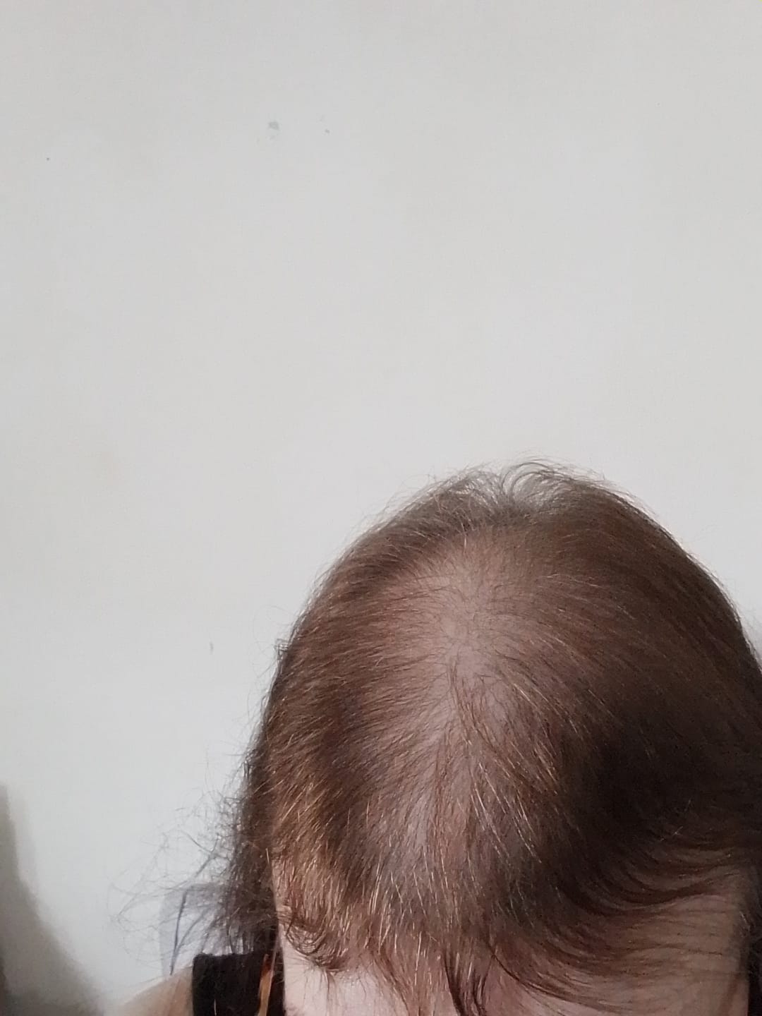 Customer photo review of SÉRUM CAPILLAIRE MULTI ACTIF BIO-DENSYL®
