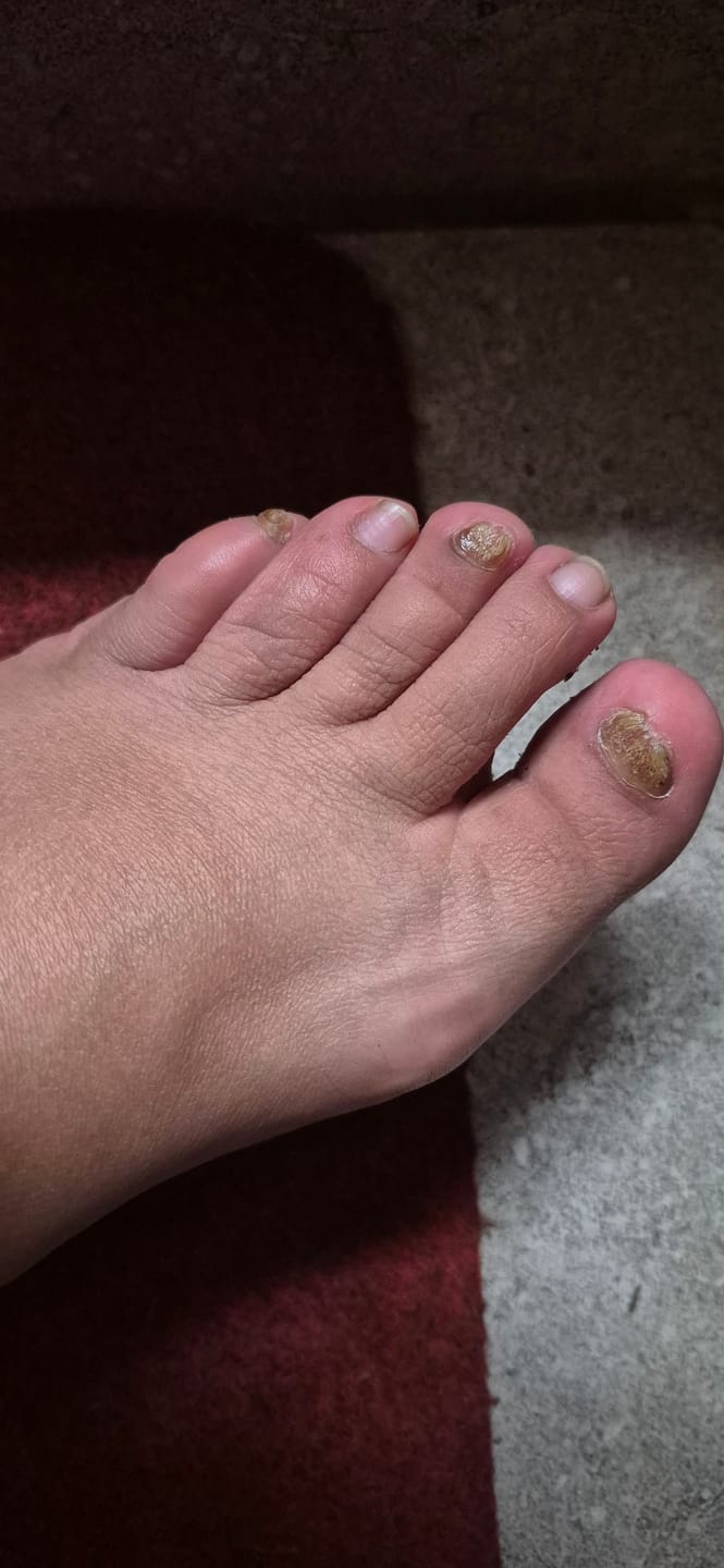 Customer photo review of Kit ByeBye Hongos – Uñas Sanas & Cuidadas