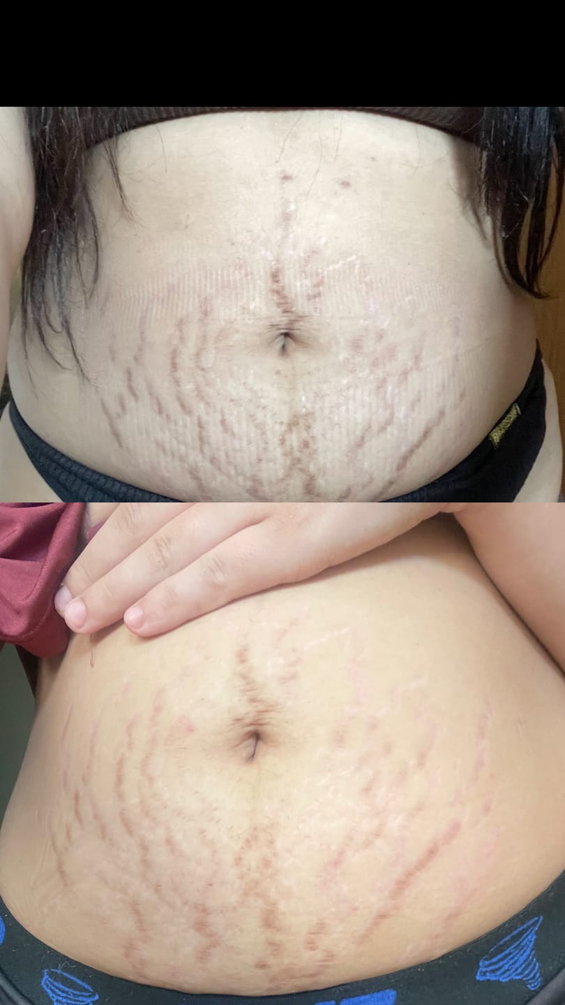 Customer photo review of Daily Tratamento - Creme Para Estrias
