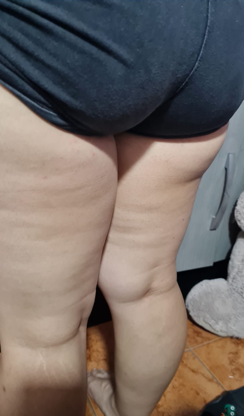 Customer photo review of Crema para Celulitis EMILY 200ml🧴🦵 con Centella y Vitamina E