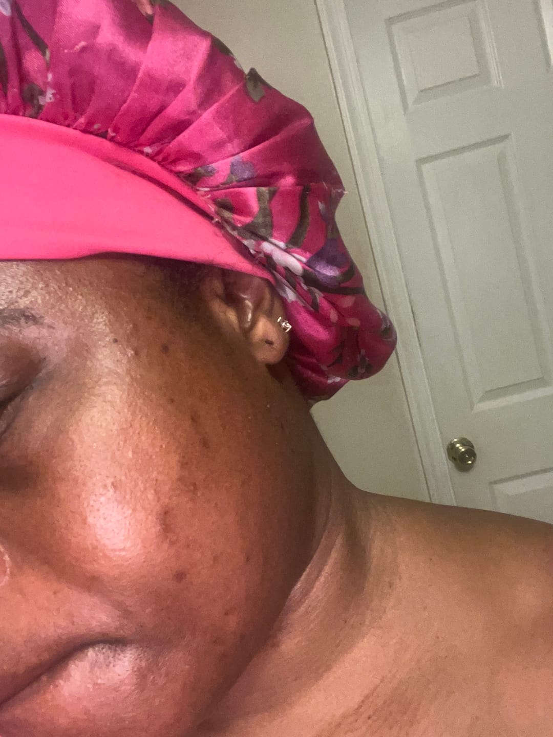 Customer photo review of BIGGER EDITION: Jolie’s Full Body & Face Brightening / Acne Kit