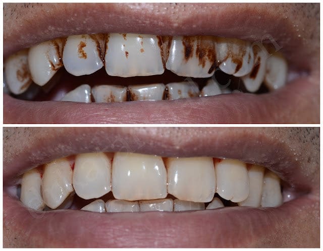 Customer photo review of Blinqo Teeth Whitening Pen