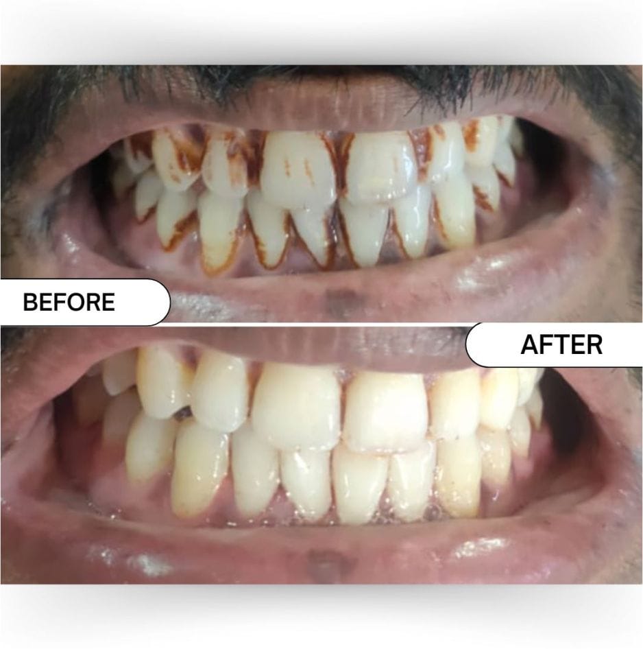 Customer photo review of Blinqo Teeth Whitening Pen