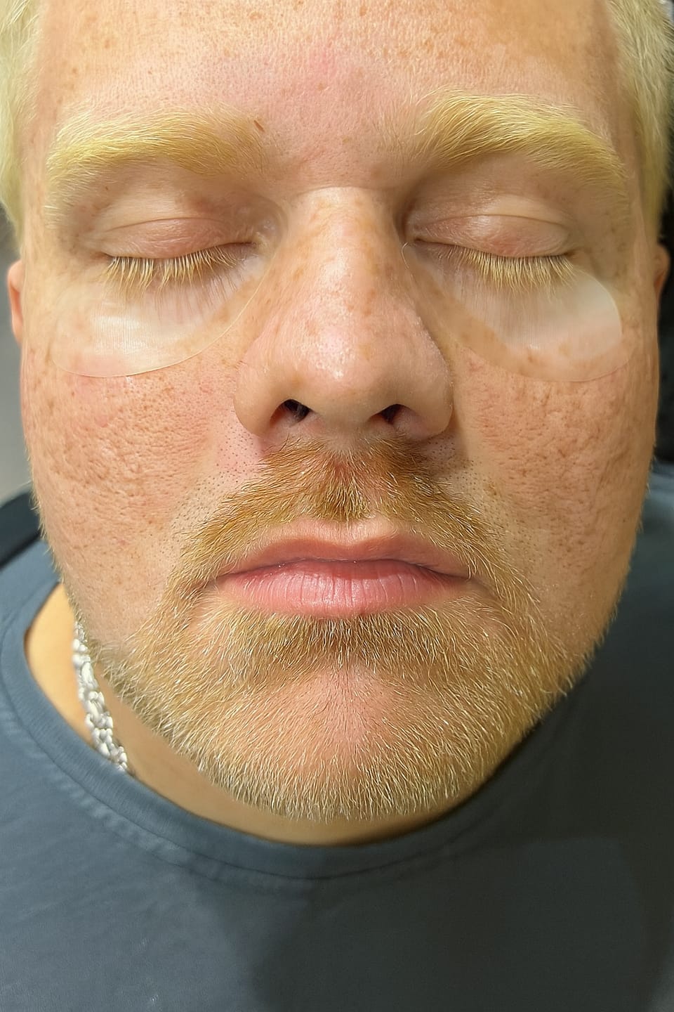 Customer photo review of Under-Eye Micro Infusion Dissolving Hyaluronic Microneedle Eye Patches