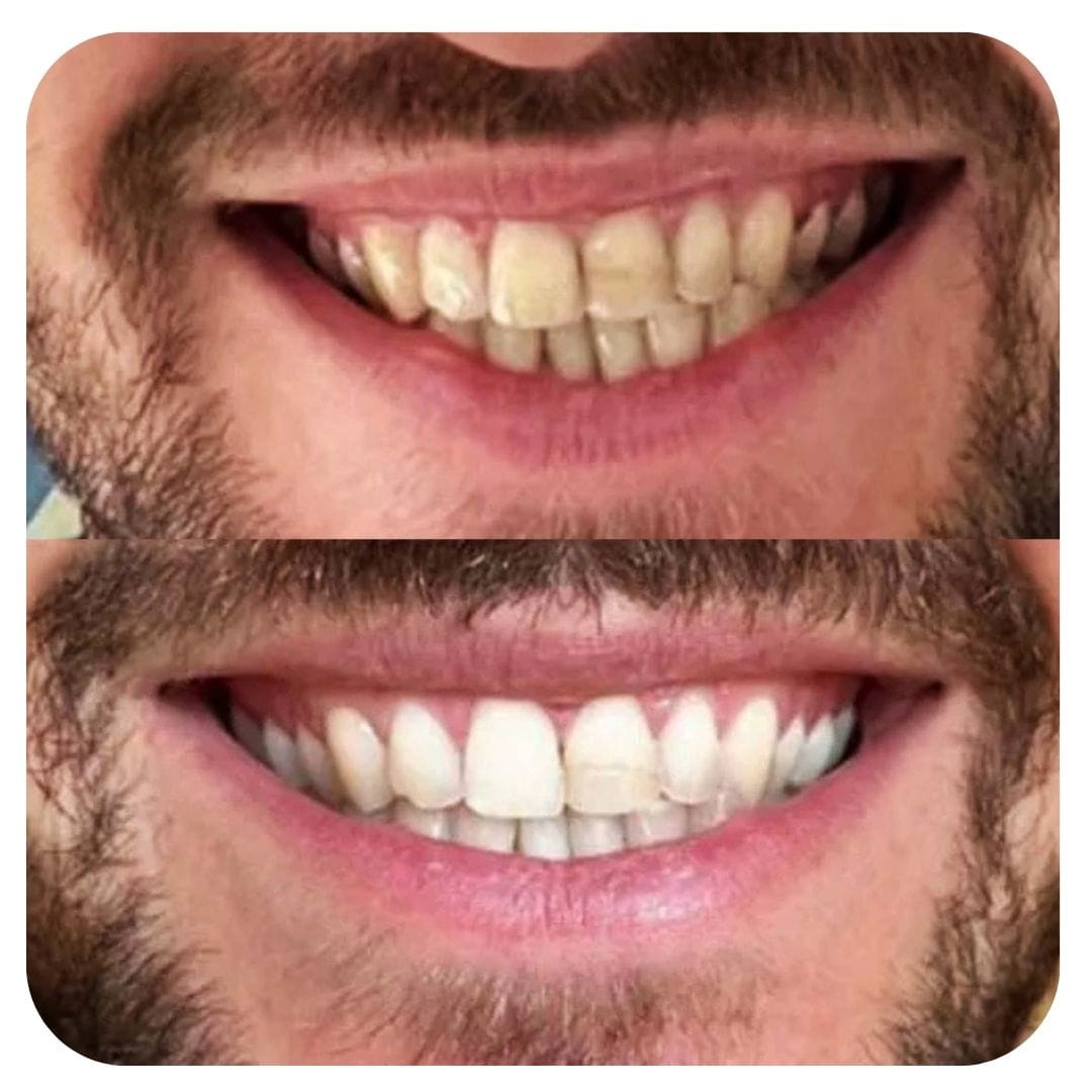 Customer photo review of Blinqo Teeth Whitening Pen